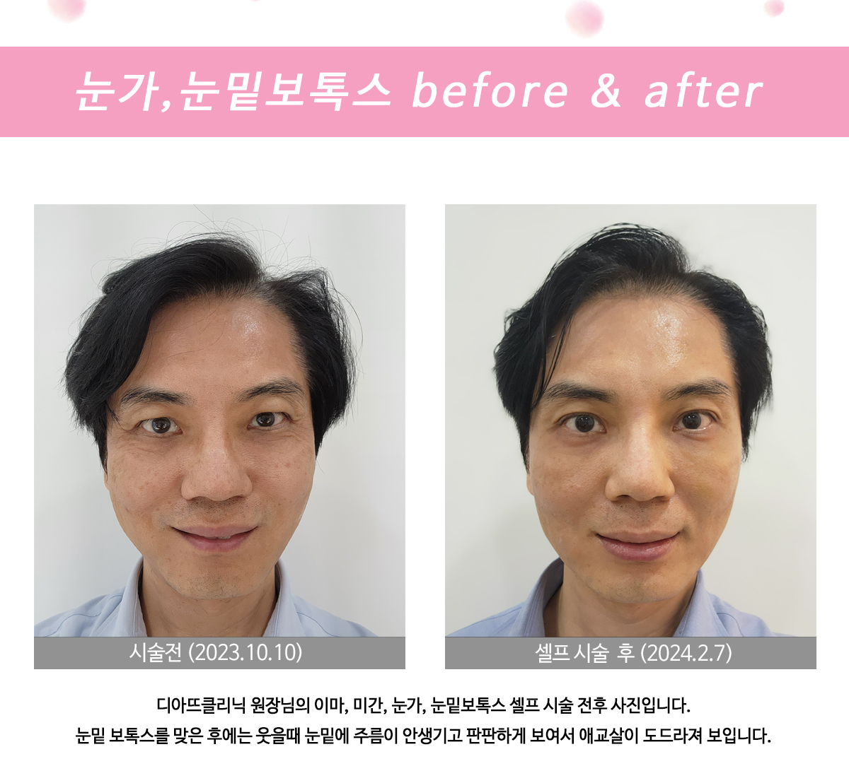 보톡스 전체 안내 자료 1